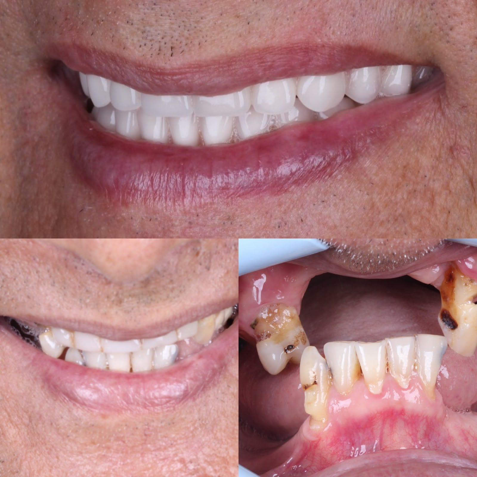 Caso clínico enviado pela Sorridi com fotos antes e após a reabilitação