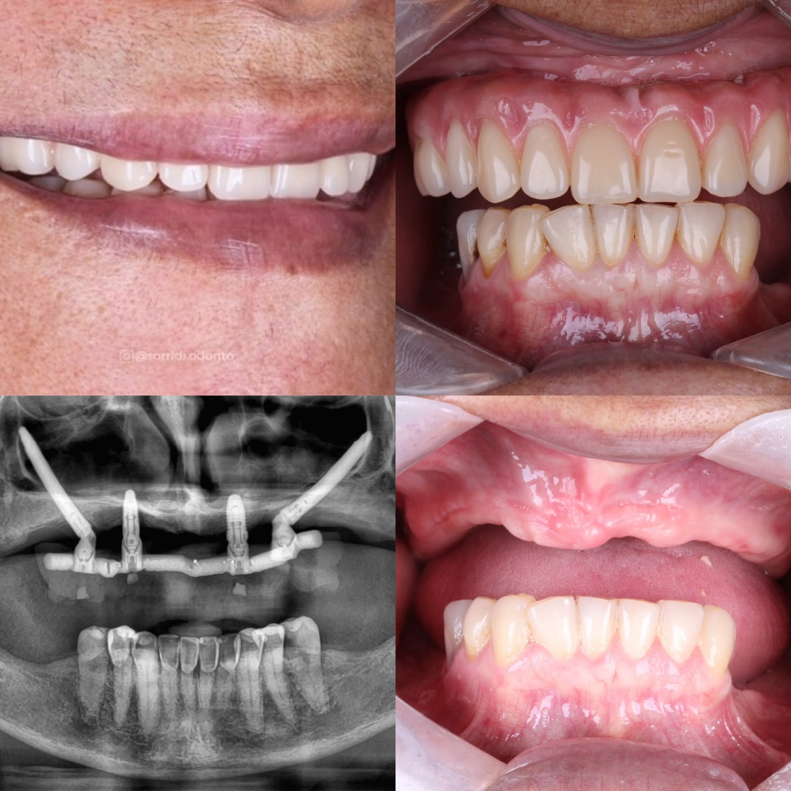Registros do tratamento, exames e sorriso de um paciente da Sorridi