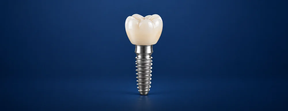 Ilustração de implante unitário: coroa de um dente sobre pilar e implante de titânio