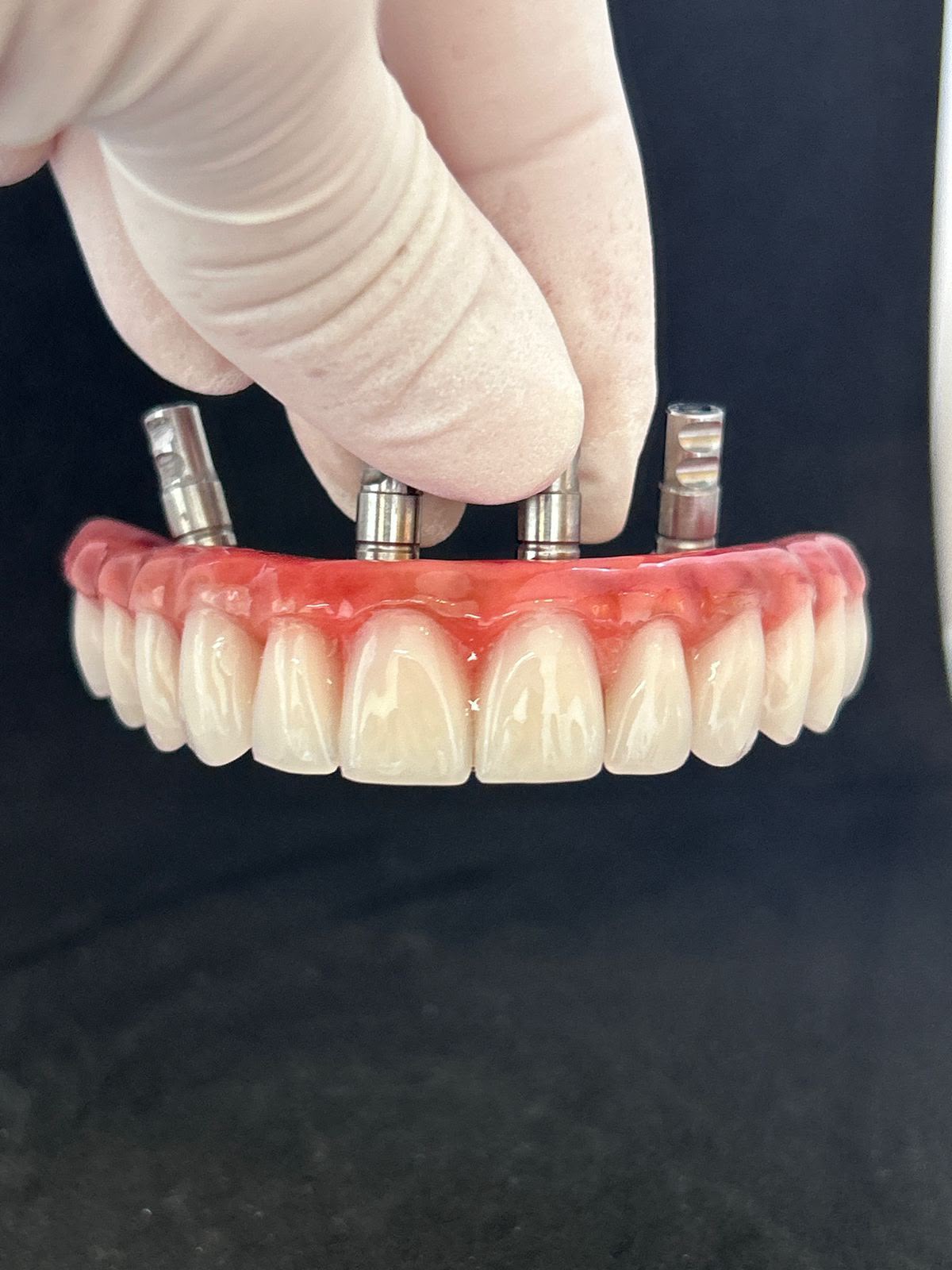 Prótese sobre quatro apoios, em modelo demonstrativo da clínica